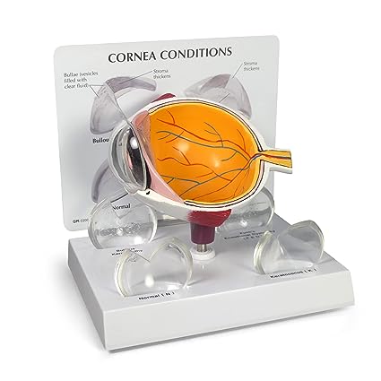 ESQUEMA DE OJO QUERATOCONO
